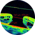 Buraco Macular