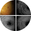 Oclusões Venosas Retinianas