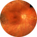 Retinose Pigmentar